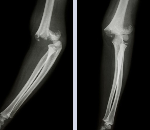 Dislocation de l'articulation du coude