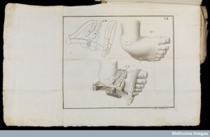 Orthotic supply of the club foot