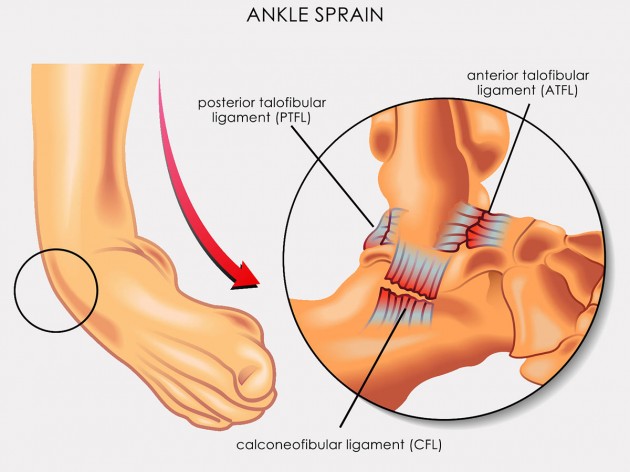 Ankle sprain