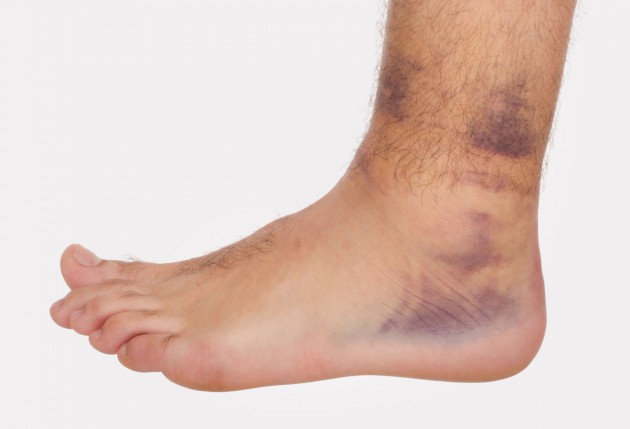 Ankle Sprain