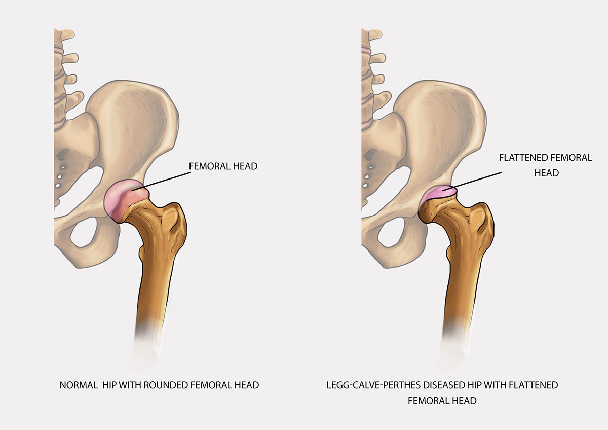 Children hip brace AM‑SB/1R