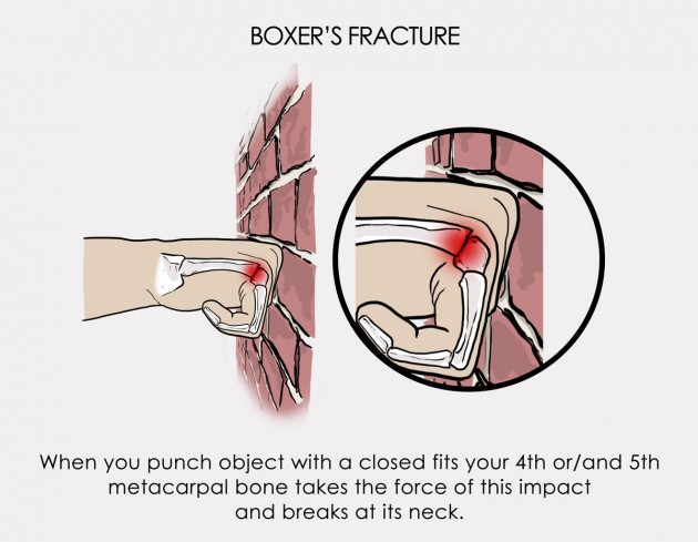 Boxer’s fracture