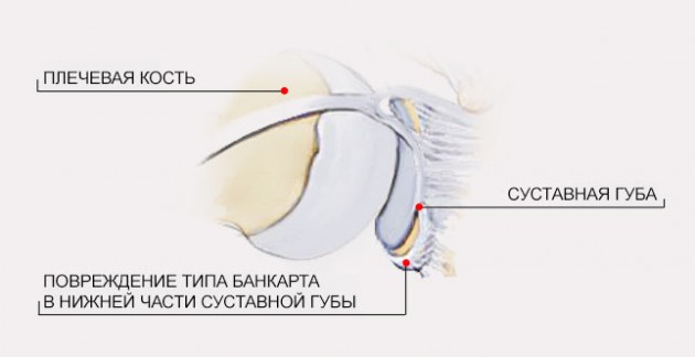 Плечевой сустав повреждение банкарта 19