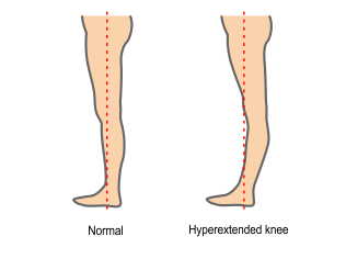Hyperextended Knee