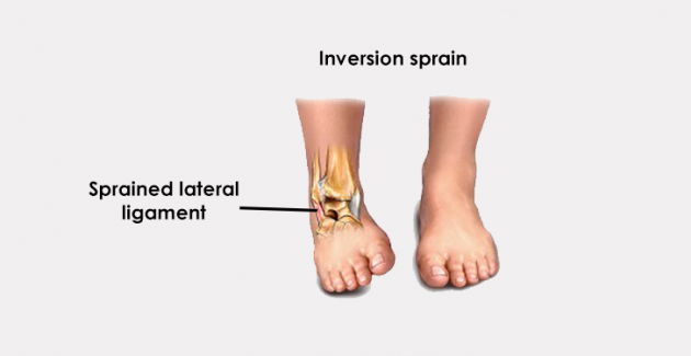 Lateral ligament injury of the ankle
