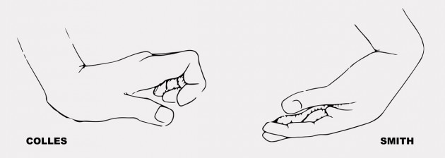 Colles and Smith’s fracture