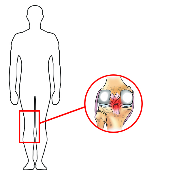 Functional knee brace RAPTOR SHORT  Reh4Mat – lower limb orthosis and  braces - Manufacturer of modern orthopaedic devices