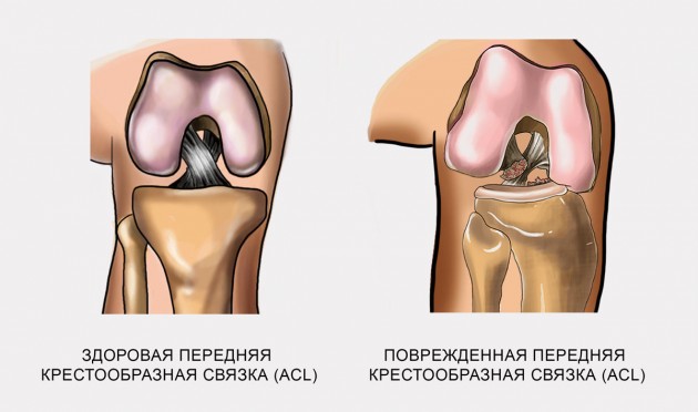 Повреждение передней крестообразной связки (ACL)