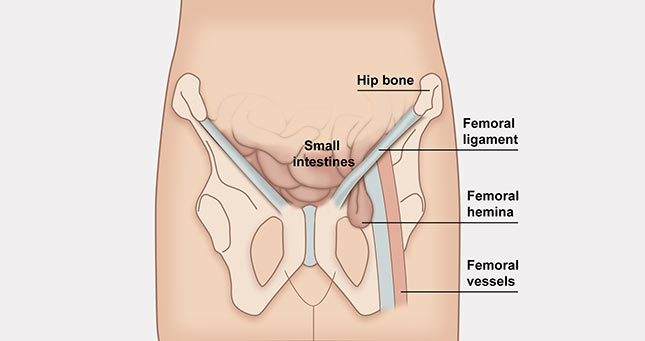 Hernia