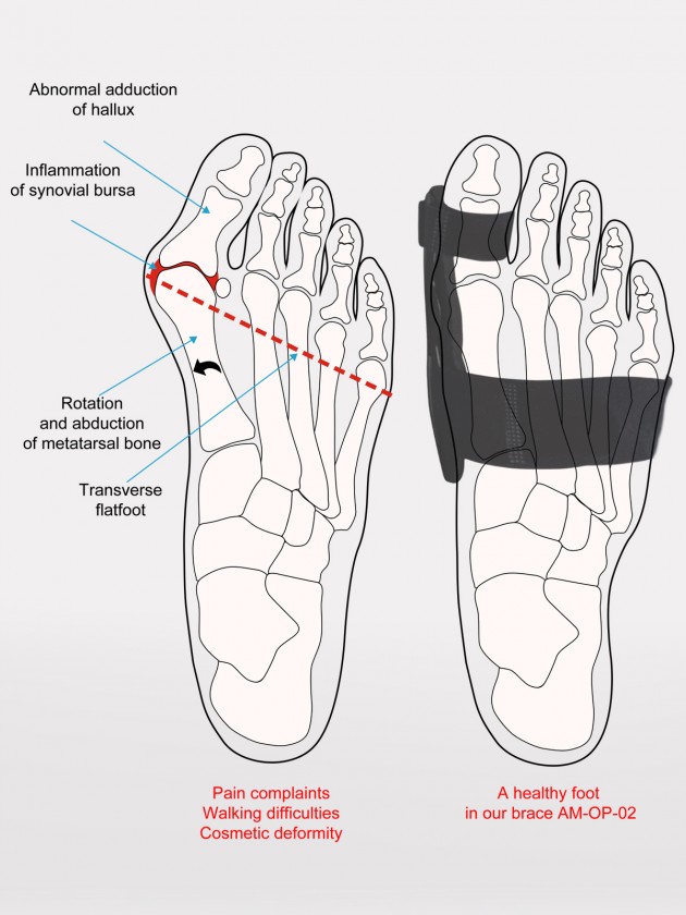 bunion splint