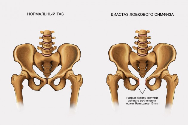 Диастаз лобкового симфиза
