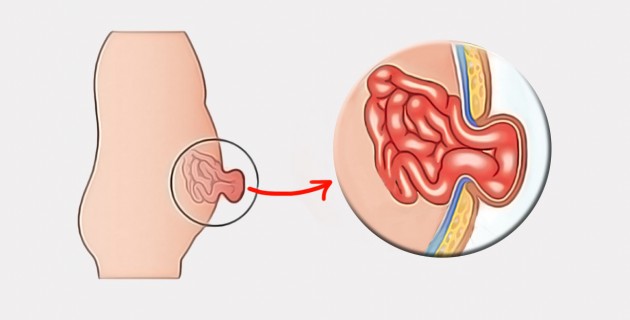 Umbilical hernia