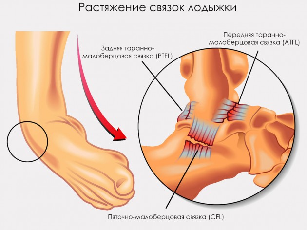 Растяжение связок лодыжки