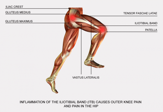 Iliotibial band syndrome (ITBS)