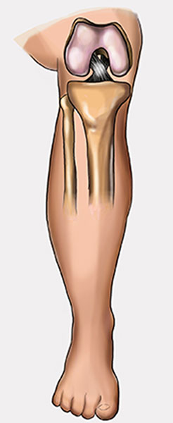 Anterior cruciate ligament ACL before the injury