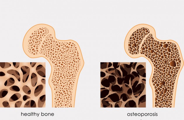 Osteoporosis