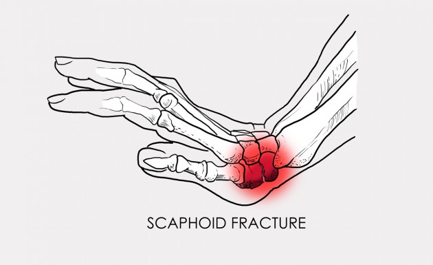 Scaphoid fracture