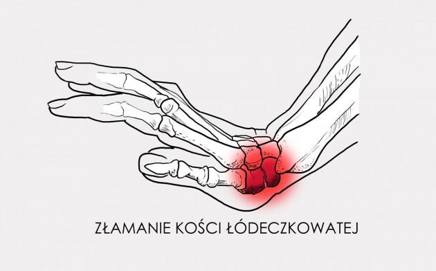 Złamanie kości łódeczkowatej