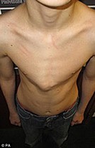 Пациент с куриной грудью до лечения