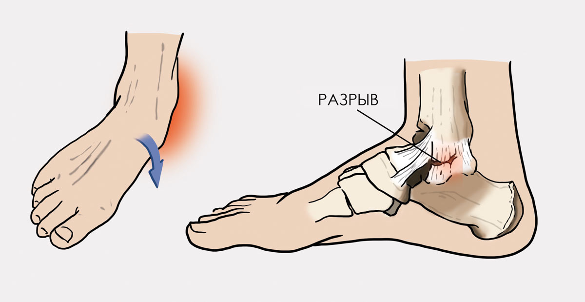 Подвернул голеностопного сустава