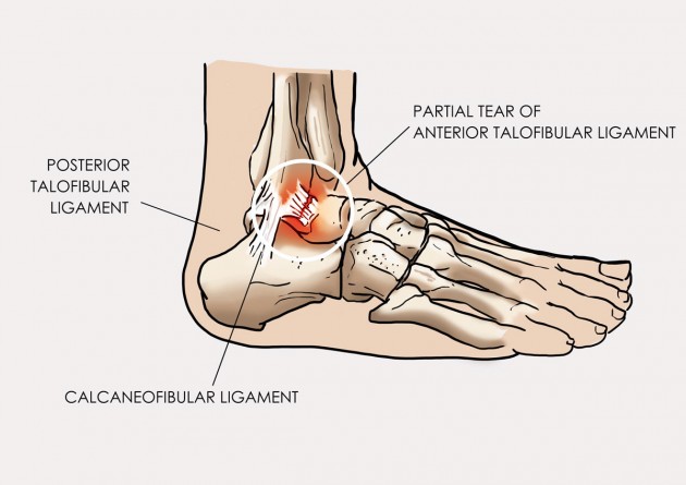 Ankle sprain