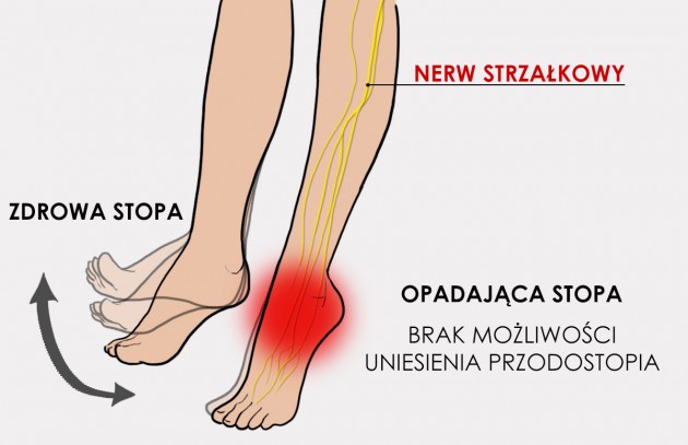 Opadająca stopa