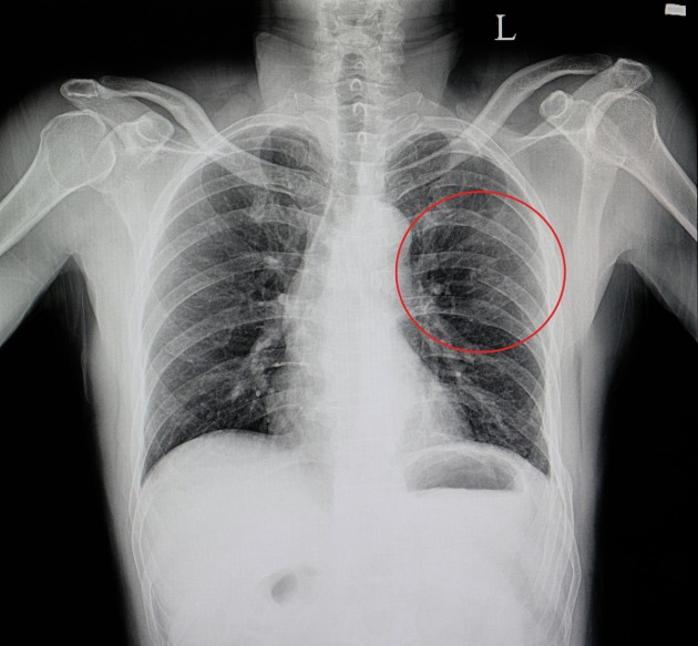 Fracture des côtes