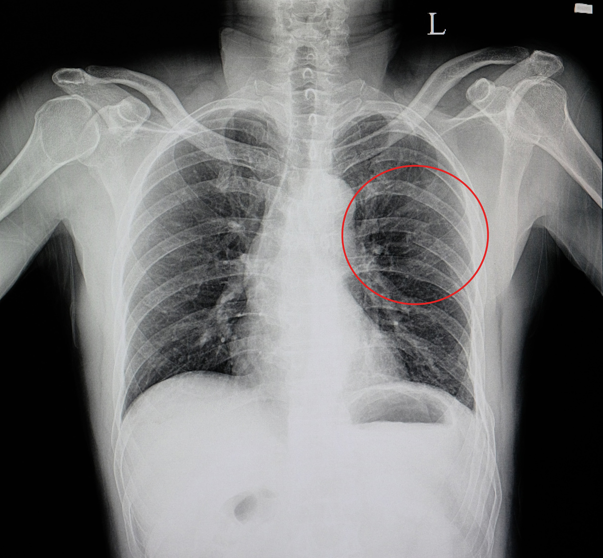 Закрытая травма легкого. Ушиб грудной клетки рентген. Грудина перелом рентген. Переломы ребер рентгенологическая картина.