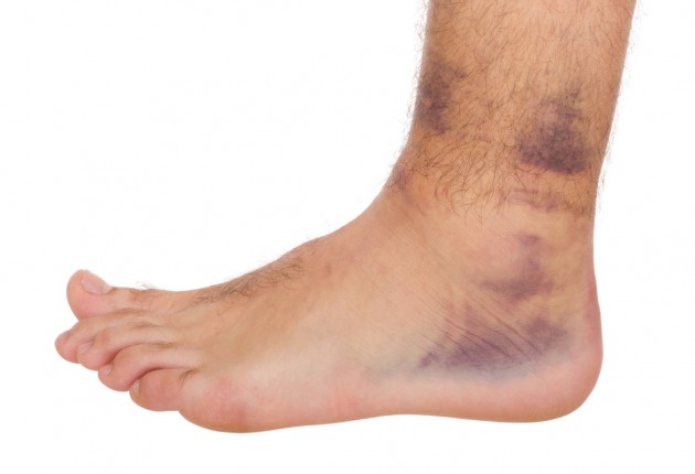 Ankle sprain