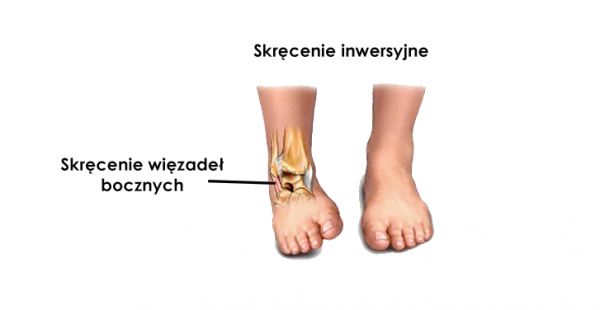 Skręcenie stawu skokowego