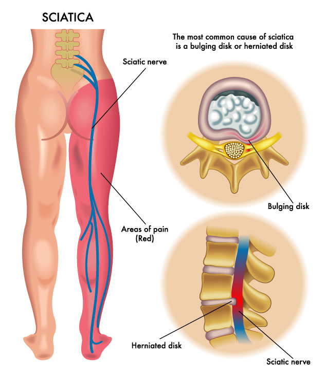 SCIATICA