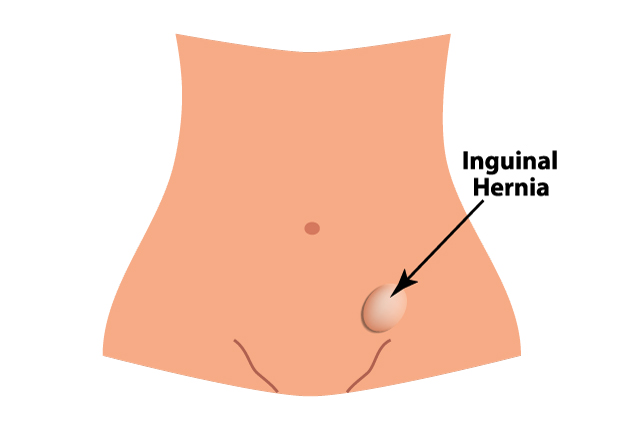 Inguinal hernia