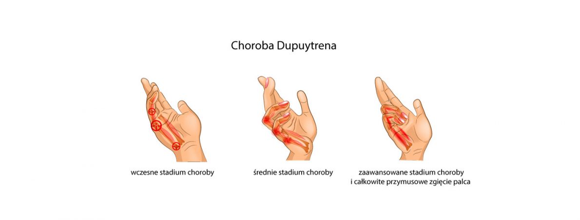 Choroba Dupuytrena