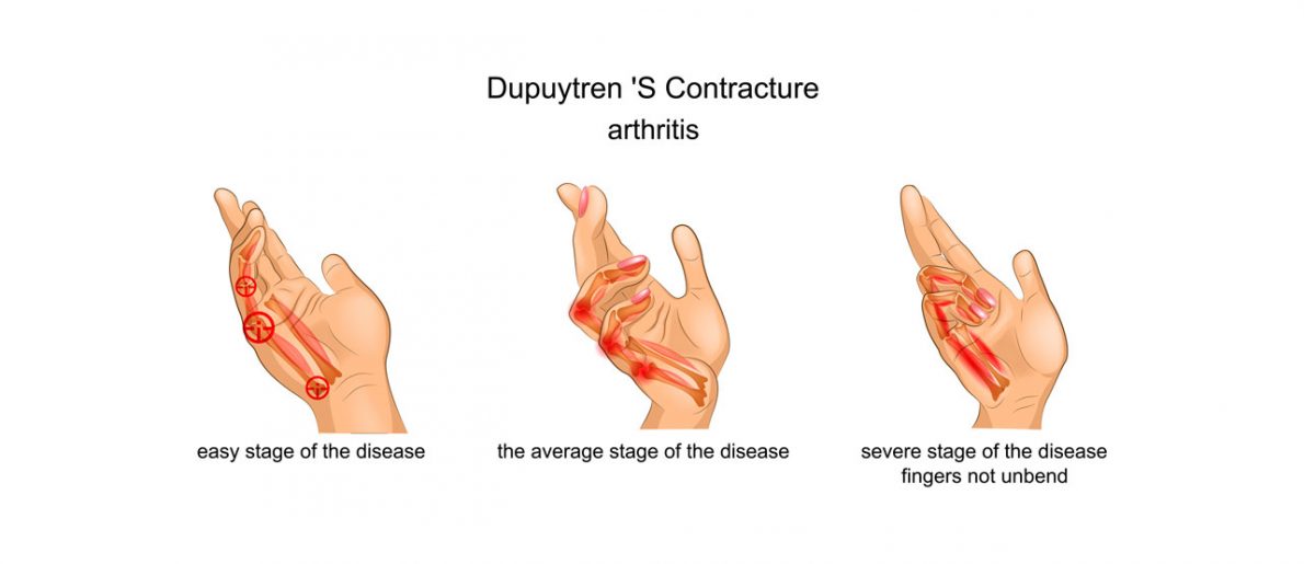 Dupuytren's Contracture