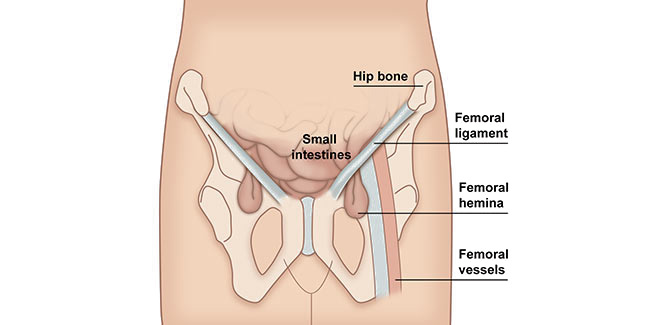 Hernia