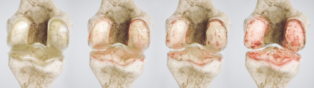 Knee osteoarthrosis