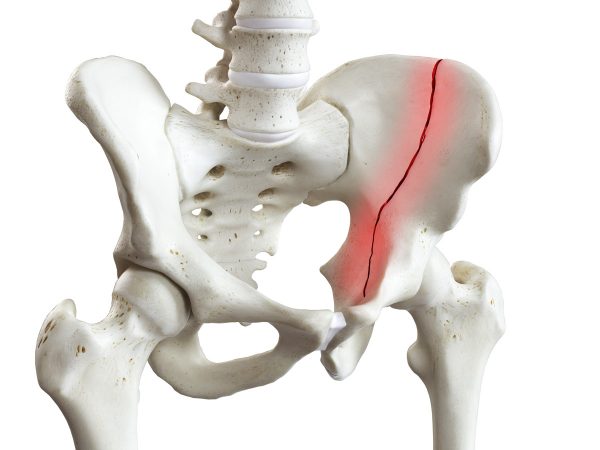 Pelvic fracture